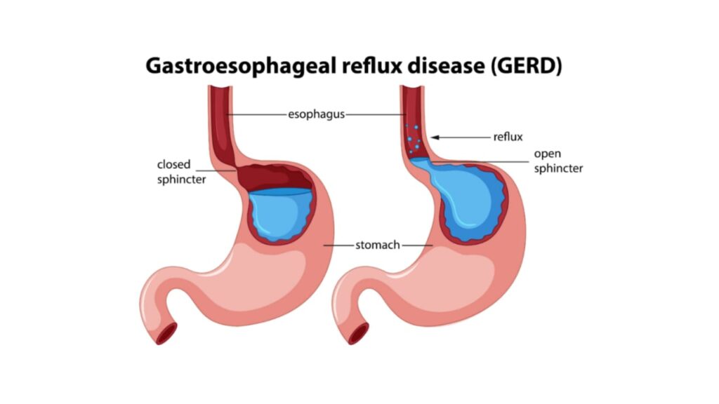 GERD (Gastroesophageal Reflux Disease)